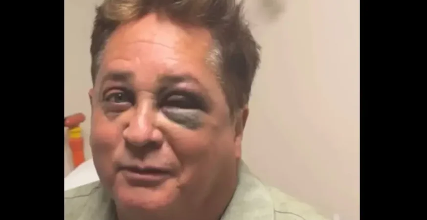 Leonardo revela fratura no rosto após queda em pescaria