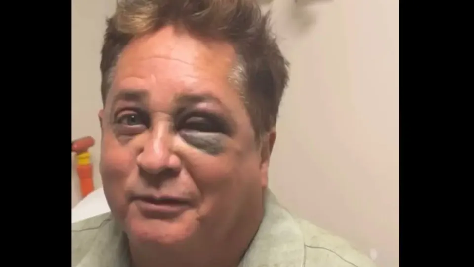 Leonardo revela fratura no rosto após queda em pescaria