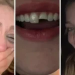Jovem quebra dente na balada no PR, cola na madrugada e volta para a festa