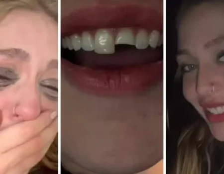 Jovem quebra dente na balada no PR, cola na madrugada e volta para a festa