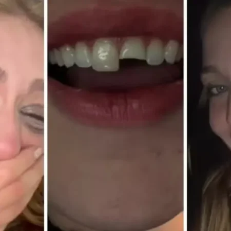 Jovem quebra dente na balada no PR, cola na madrugada e volta para a festa