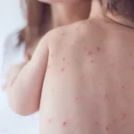 SP confirma 2 novos casos de sarampo e estado soma 7 infecções em 2026