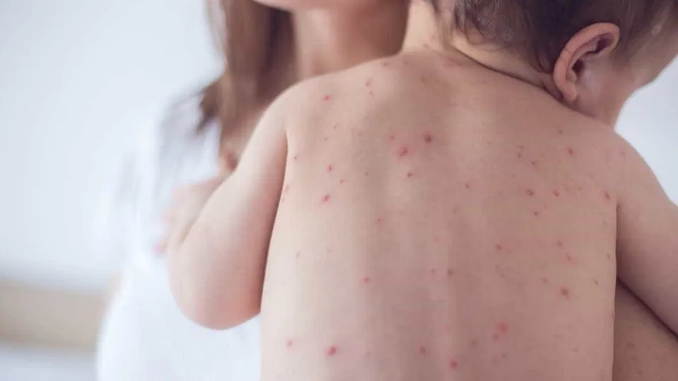 SP confirma 2 novos casos de sarampo e estado soma 7 infecções em 2026