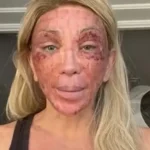Maya Massafera mostra rosto inchado após peeling e ironiza reação: