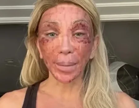 Maya Massafera mostra rosto inchado após peeling e ironiza reação:
